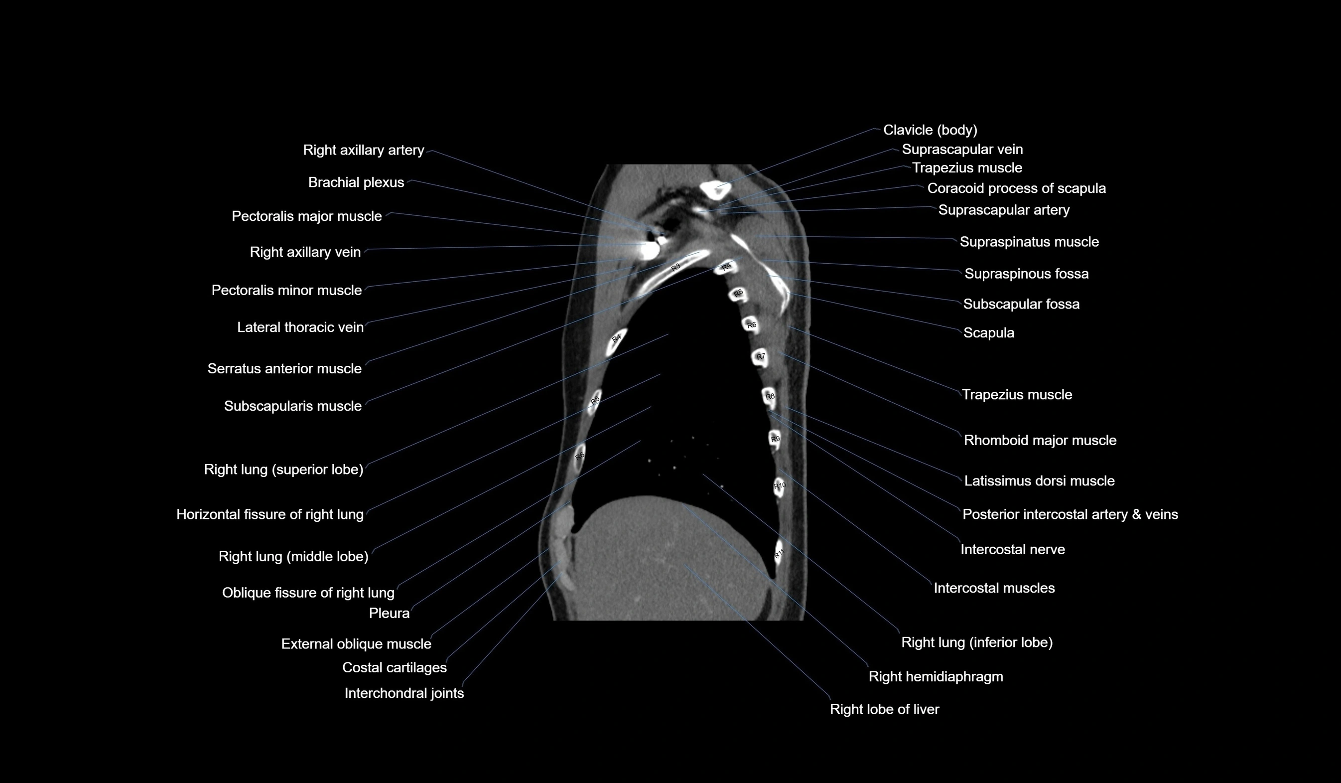 CT chest (thorax) labelled sagittal cross sectional anatomy radiology image-00029.webp